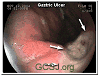 GASTRIC ULCER